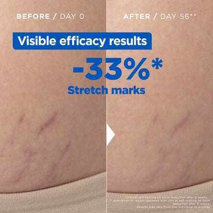 Mixa Anti Stretch Mark Oil - For Skin with Stretch Marks - With 30% Omega 6 & 9 - 100 ml