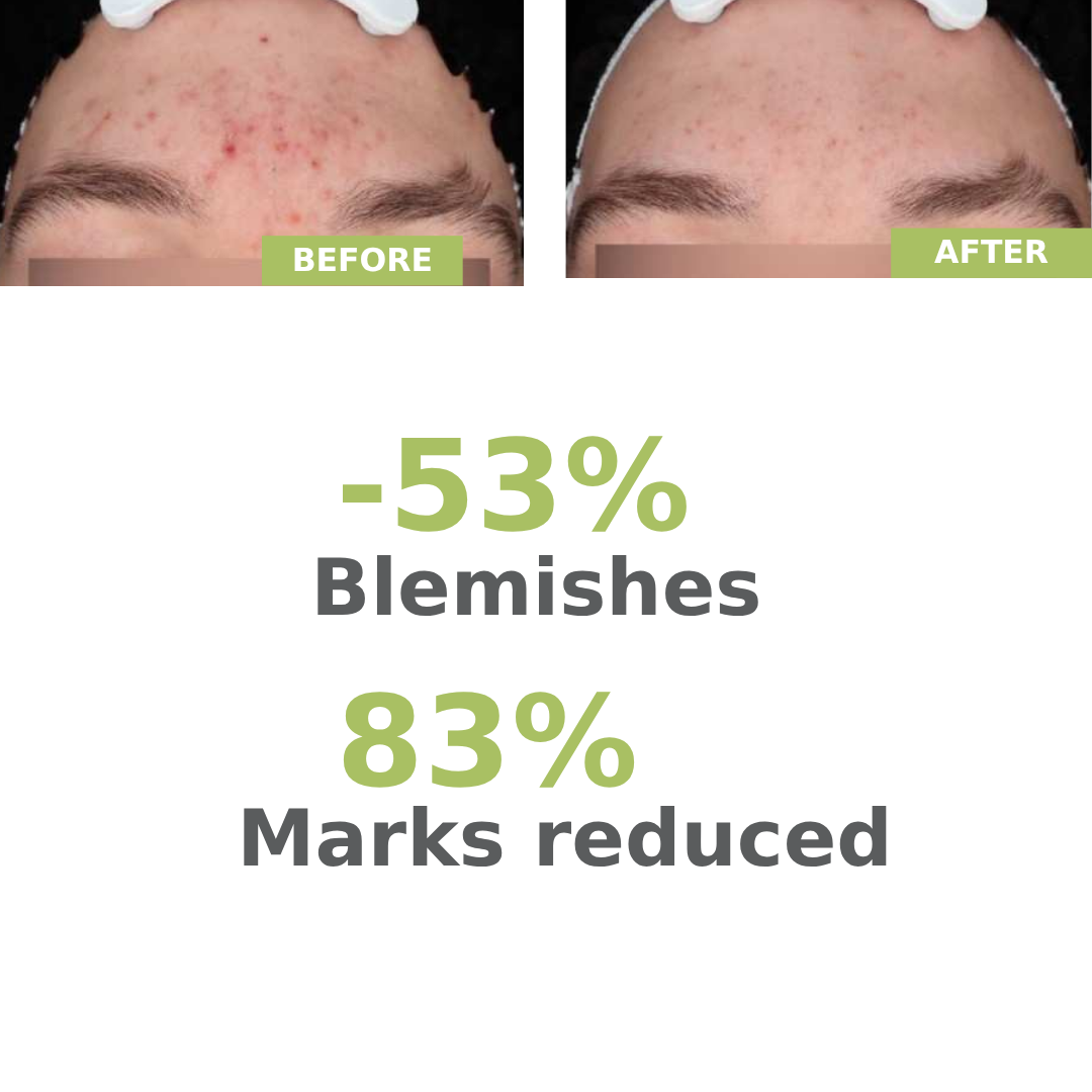 A-derma Biology AC Night Peel Anti-Blemish Serum – 6