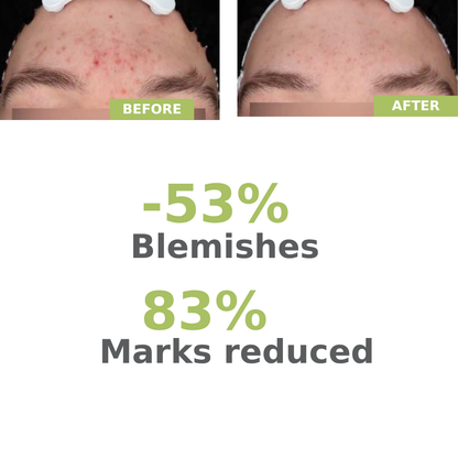 A-derma Biology AC Night Peel Anti-Blemish Serum – 6