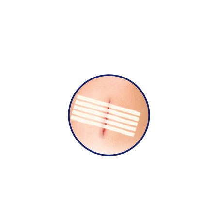 Wound Closure Adhesive Strips(0.6cm*10cm) – 2