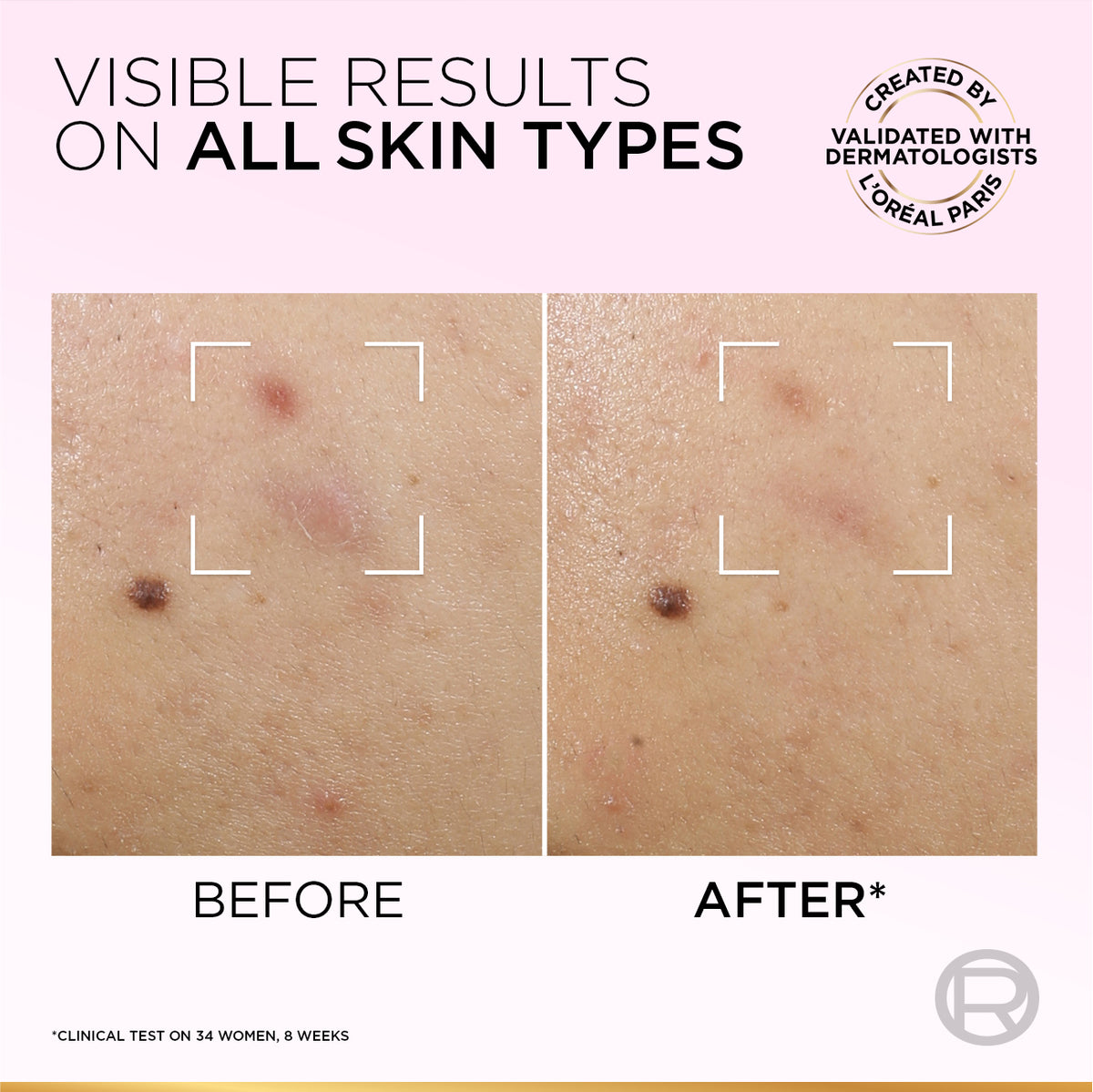 L’Oréal Paris Glycolic-Bright Anti-Dark Spot Exfoliant Peel 15% AHA + BHA + PHA + Niacinamide 25ml.