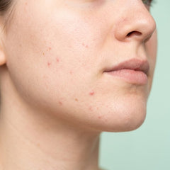 Acne & blemishes