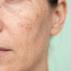 Dark spots