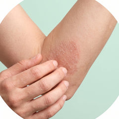 Eczema & atopic